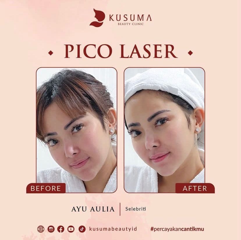 Before After Laser Pico